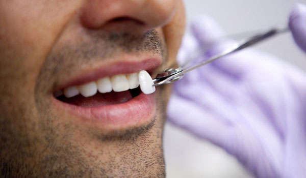 Veneers-and-Laminates